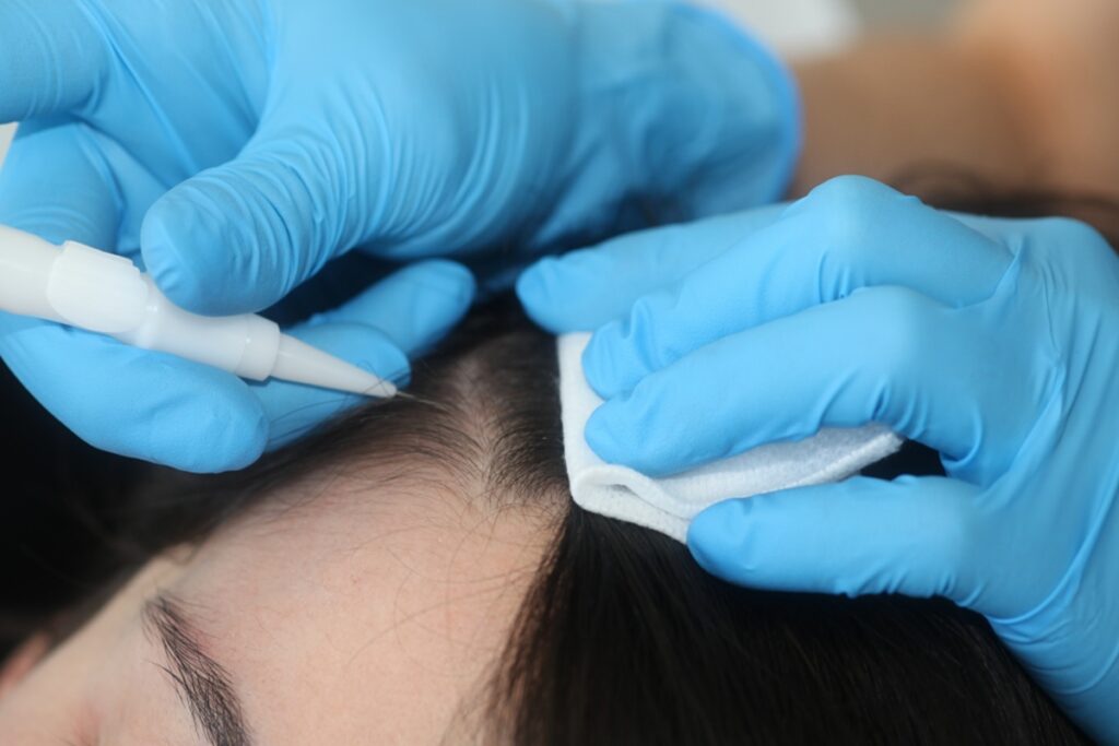 technique FUE Long Hair greffe cheveux femme